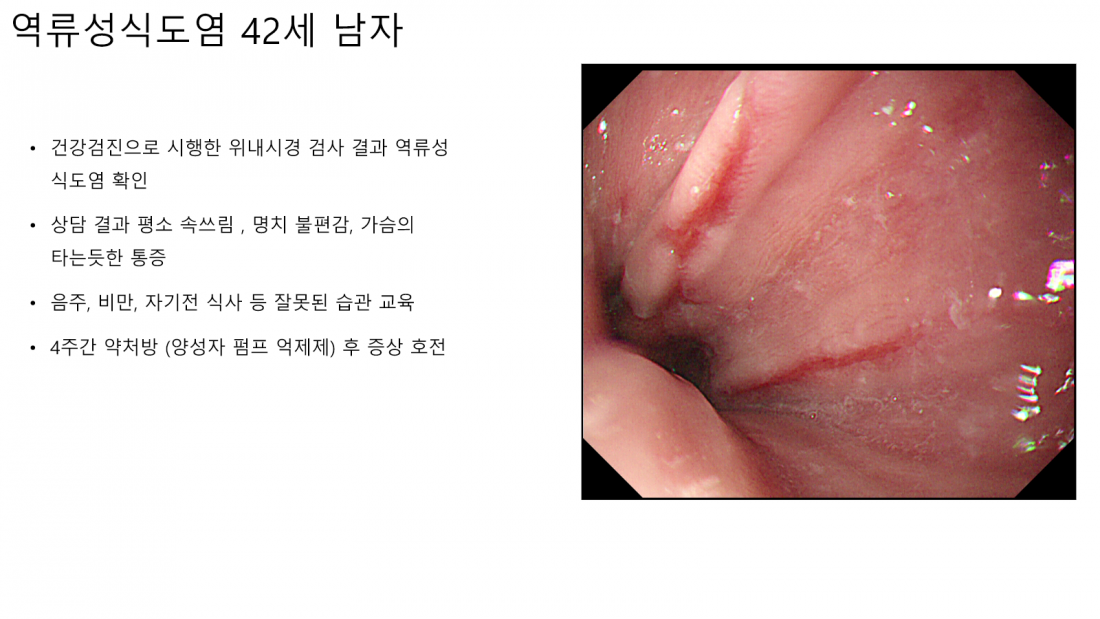 남성 역류성식도염 진단 및 치료 사례 요약