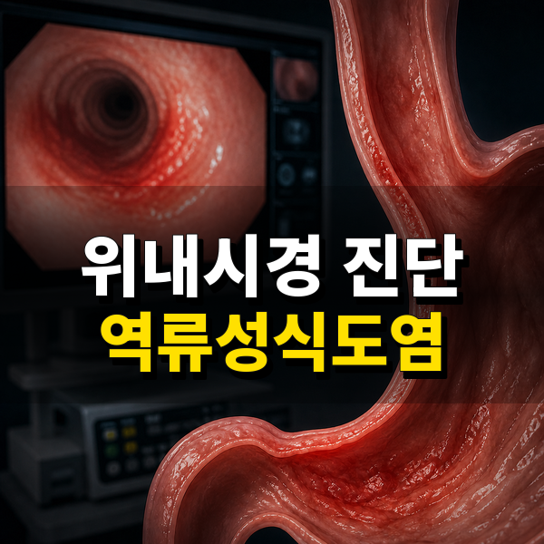 안산 건강검진센터 위내시경에서 확인된 역류성식도염 대표 이미지