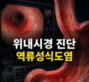 안산 건강검진센터 위내시경에서 확인된 역류성식도염